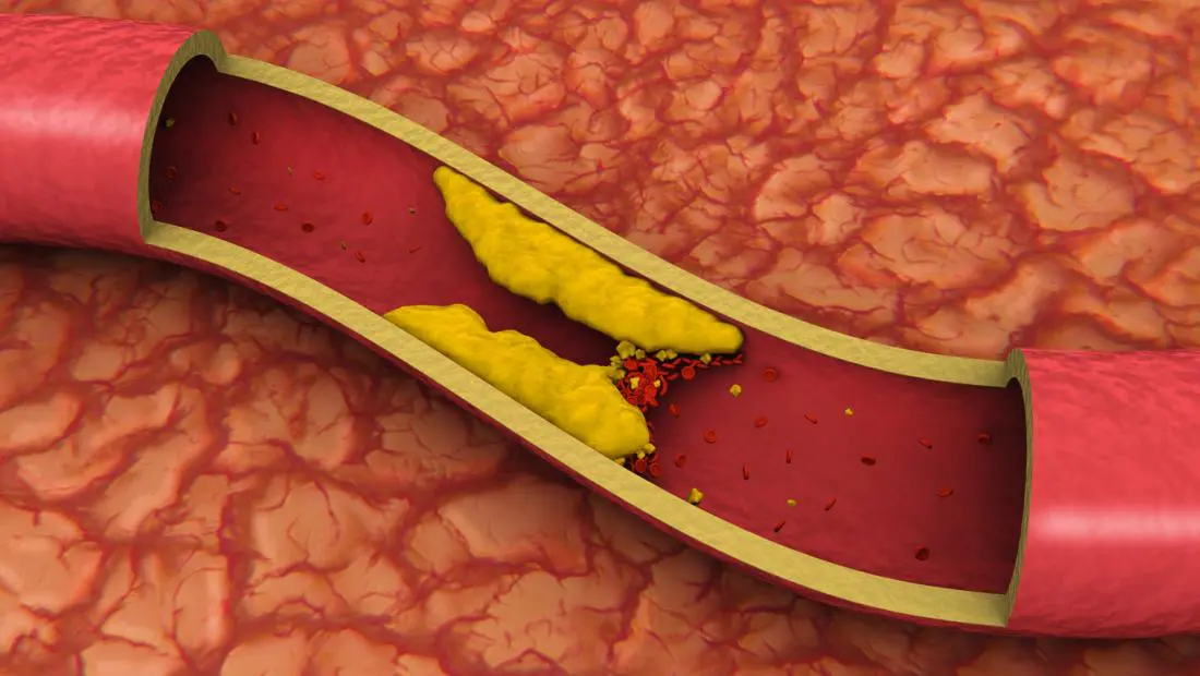 Saturated Fats Might Block Your Arteries