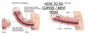 Peyronies disease is common penis problem
