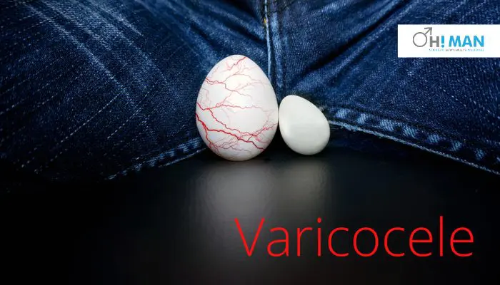 Varicoceles is cause of Testicular pain