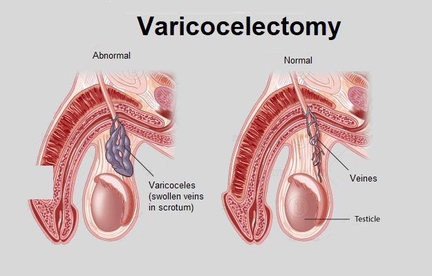 What is varicocelectomy?