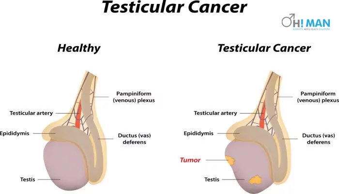 testicular cancer symptoms and anatomy